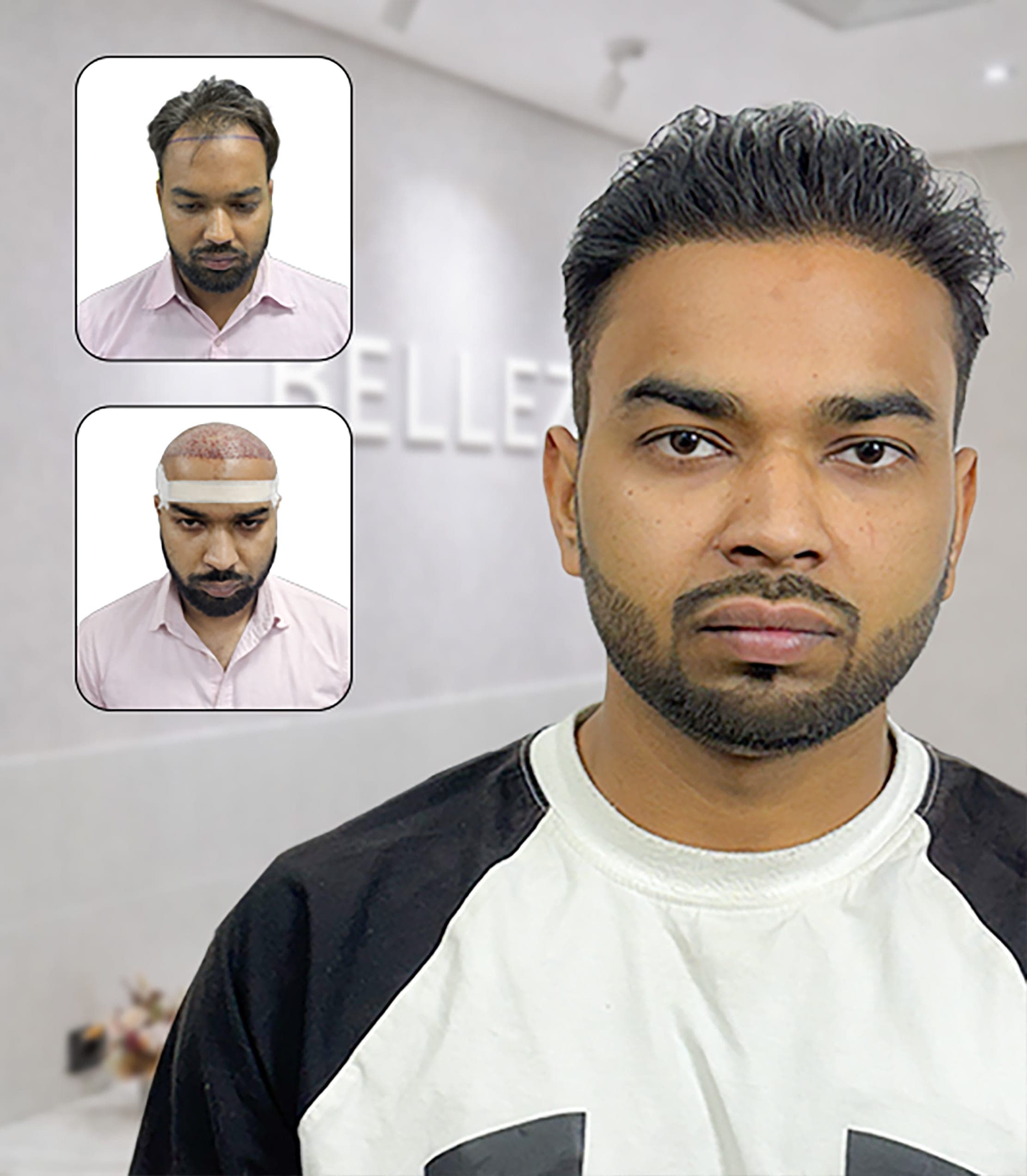 Defined Hairline Restoration with Dense Frontal Coverage