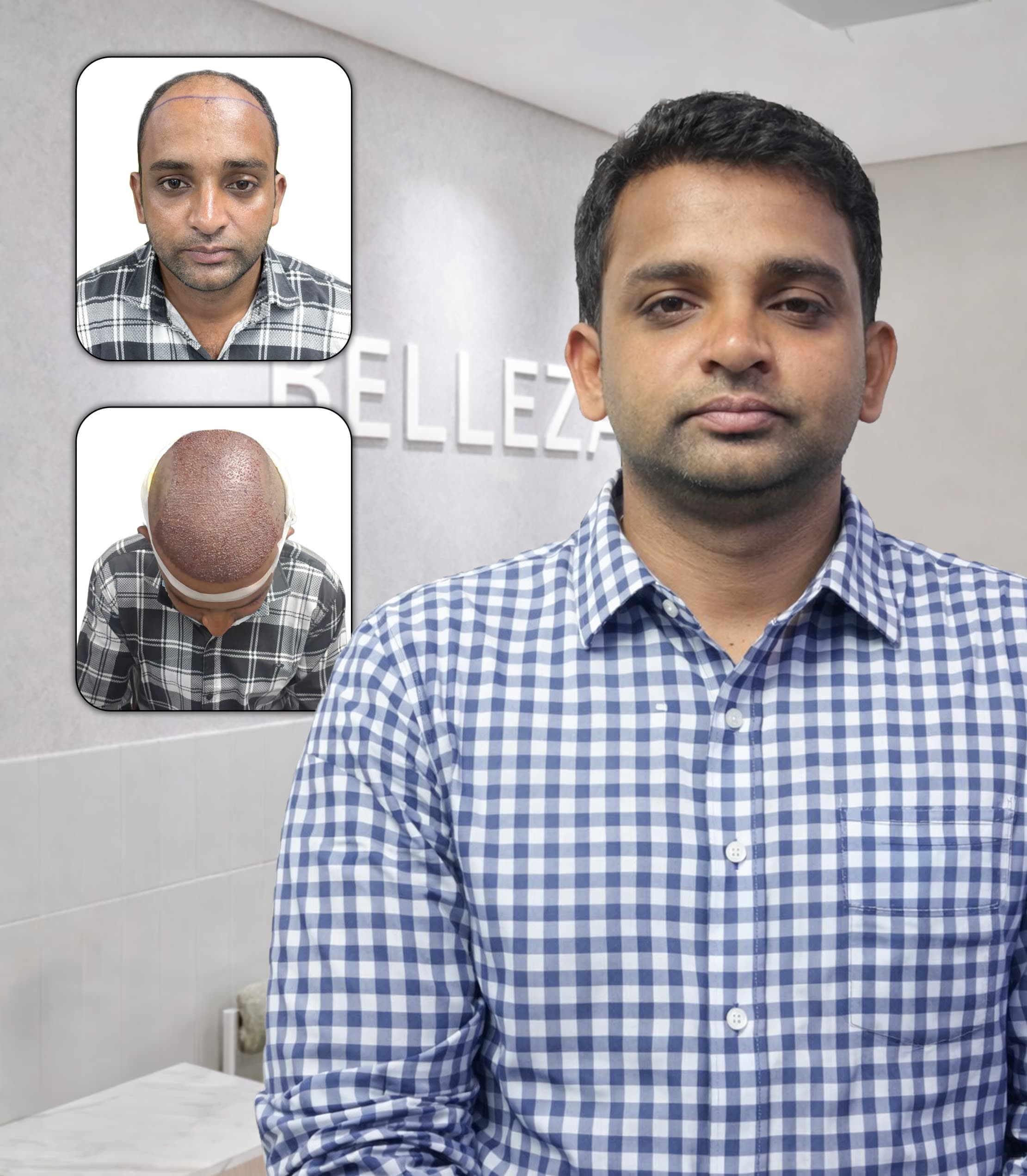 Advanced  Hair Transplant with Full Coverage Restoration
