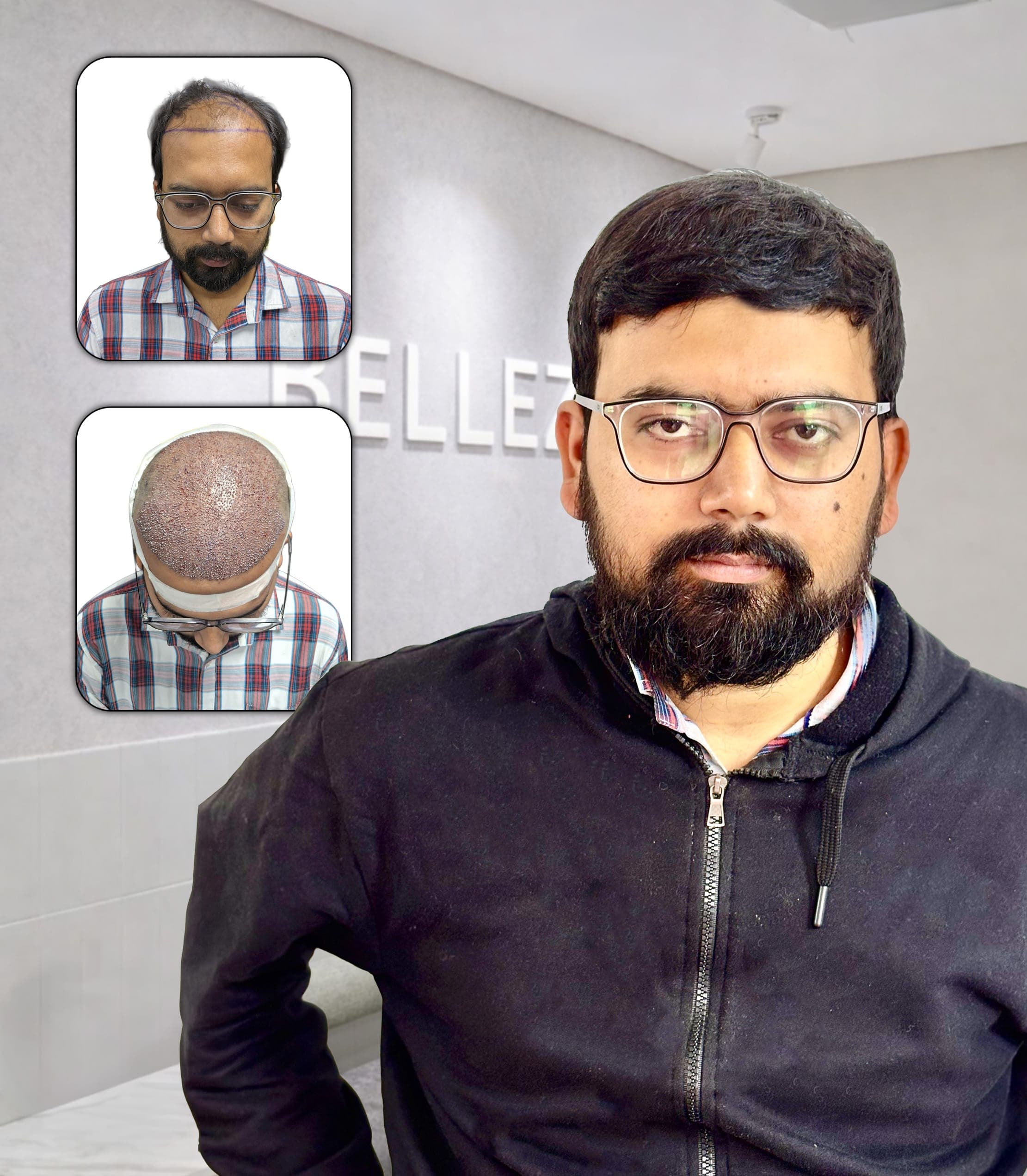 Precision  Hairline Design with Natural Density Enhancement