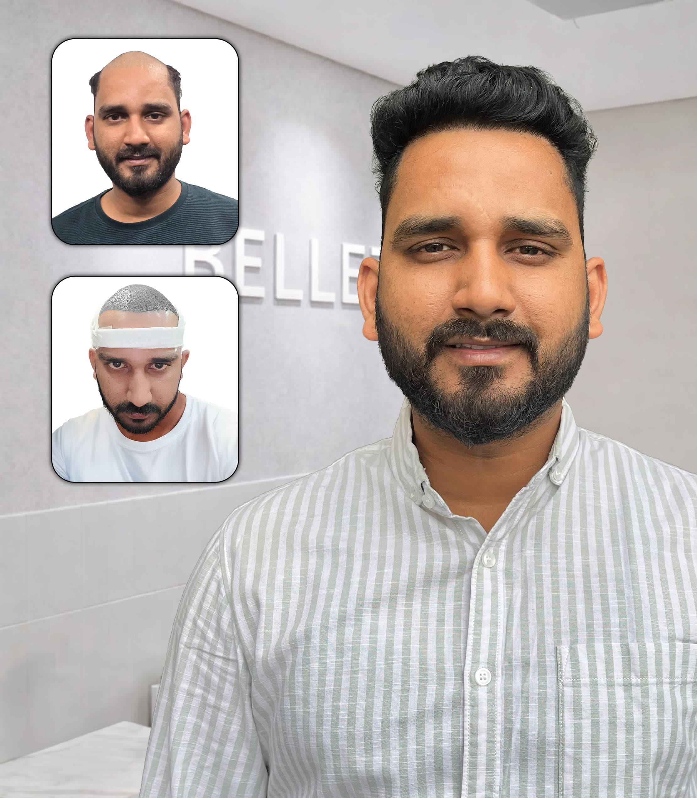 Complete Hairline Revival with Strong Frontal Density