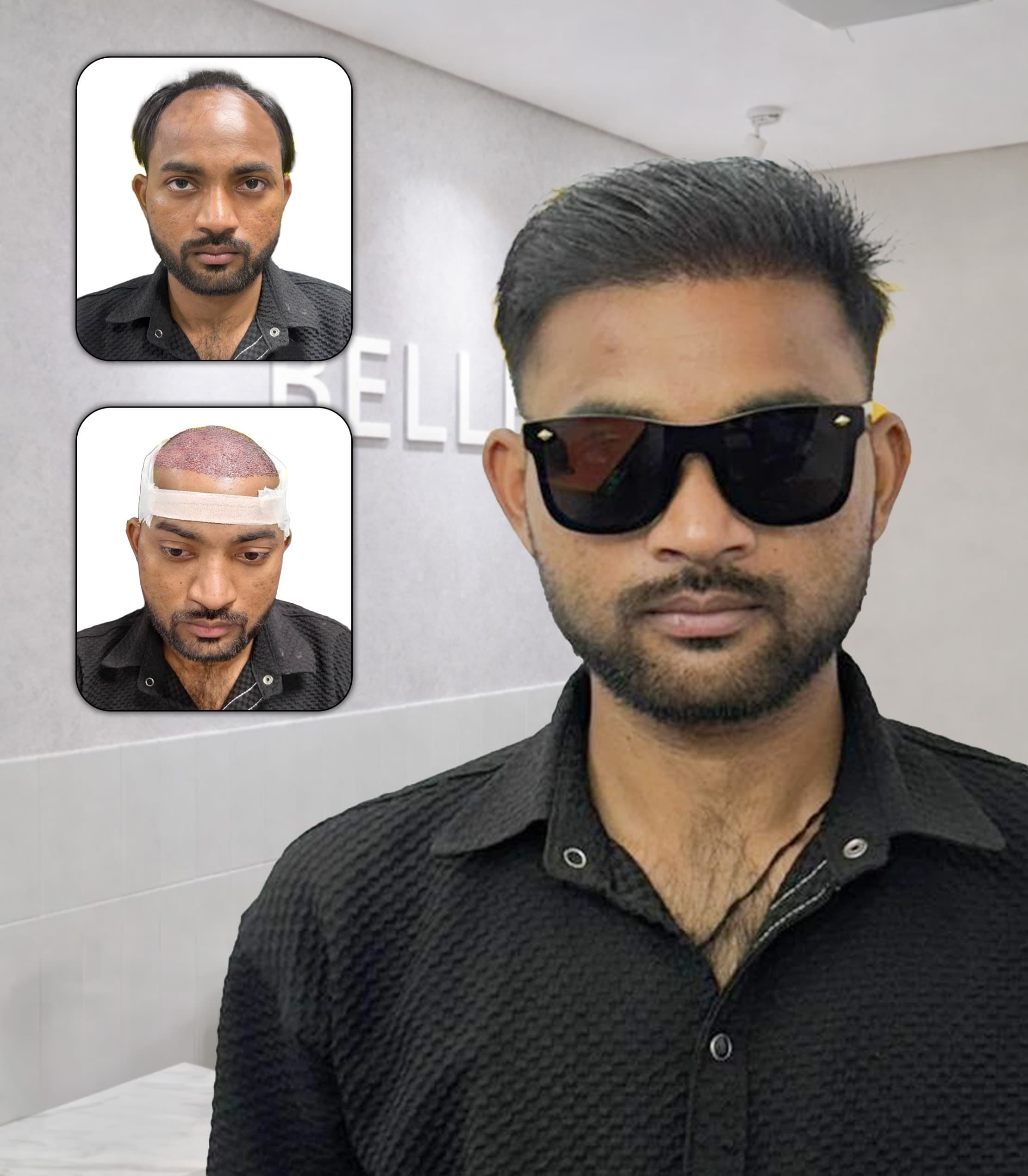 High-Density Hair Transplant with Full Scalp Coverage