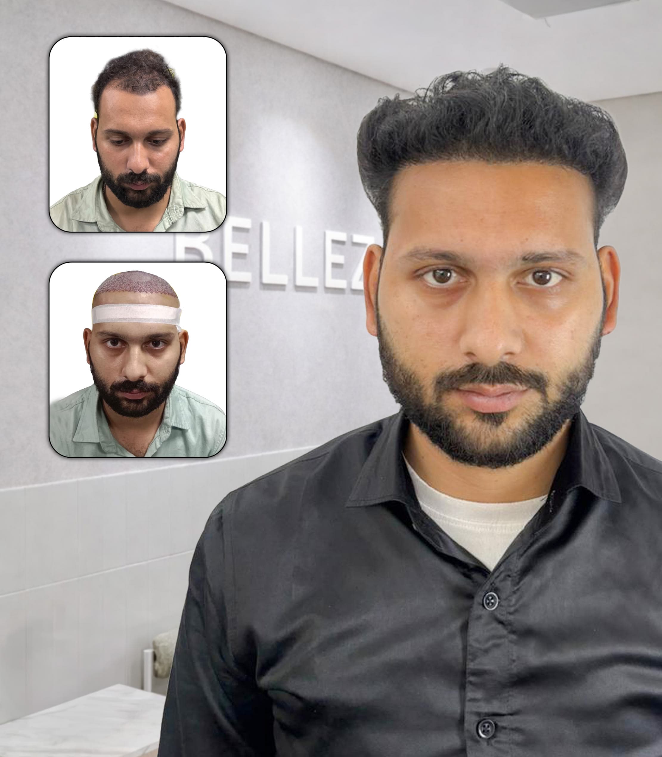 Comprehensive FUE Hair Restoration with Frontal Hairline Reconstruction