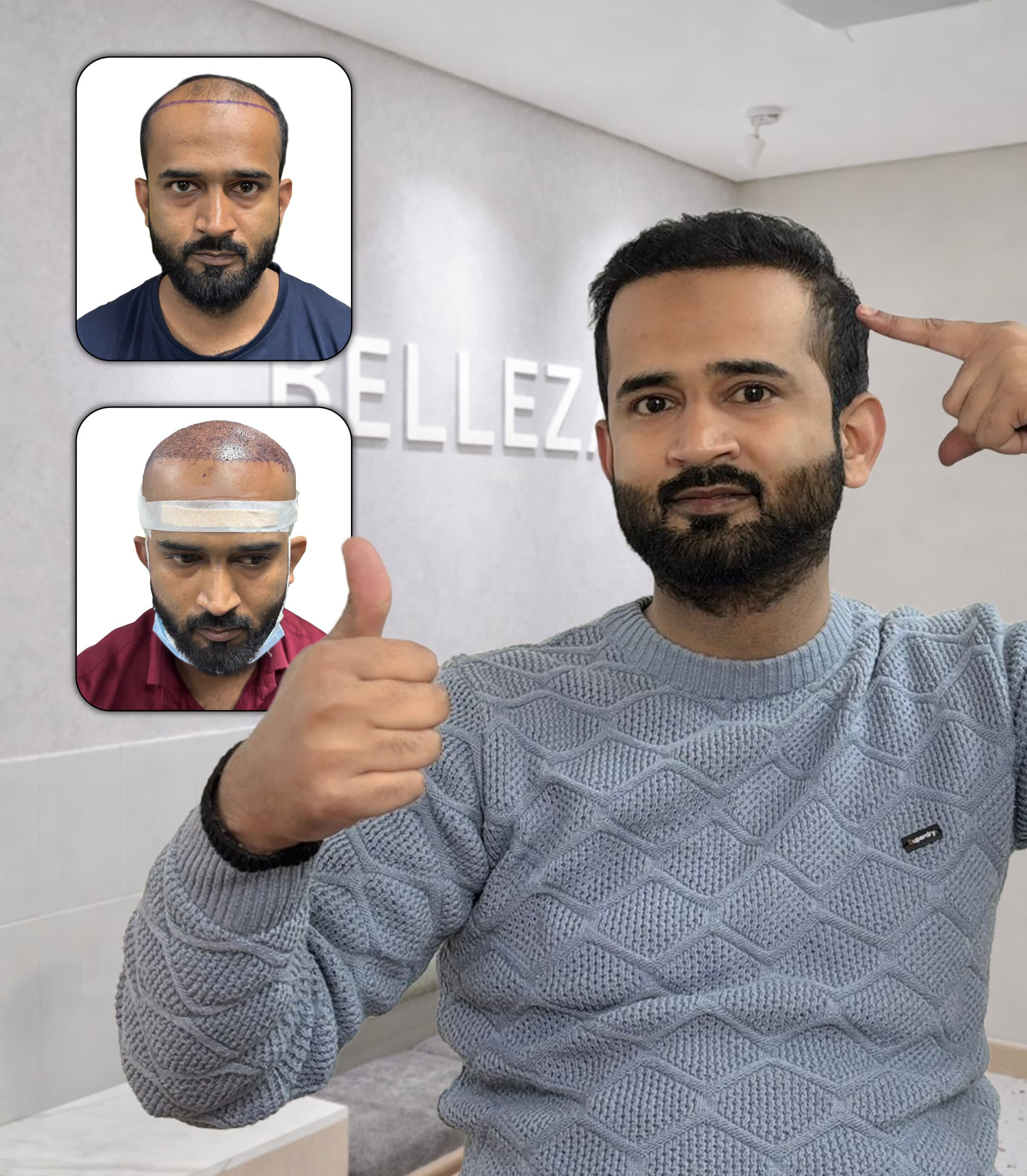 Frontal Hairline Restoration with Enhanced Density & Coverage