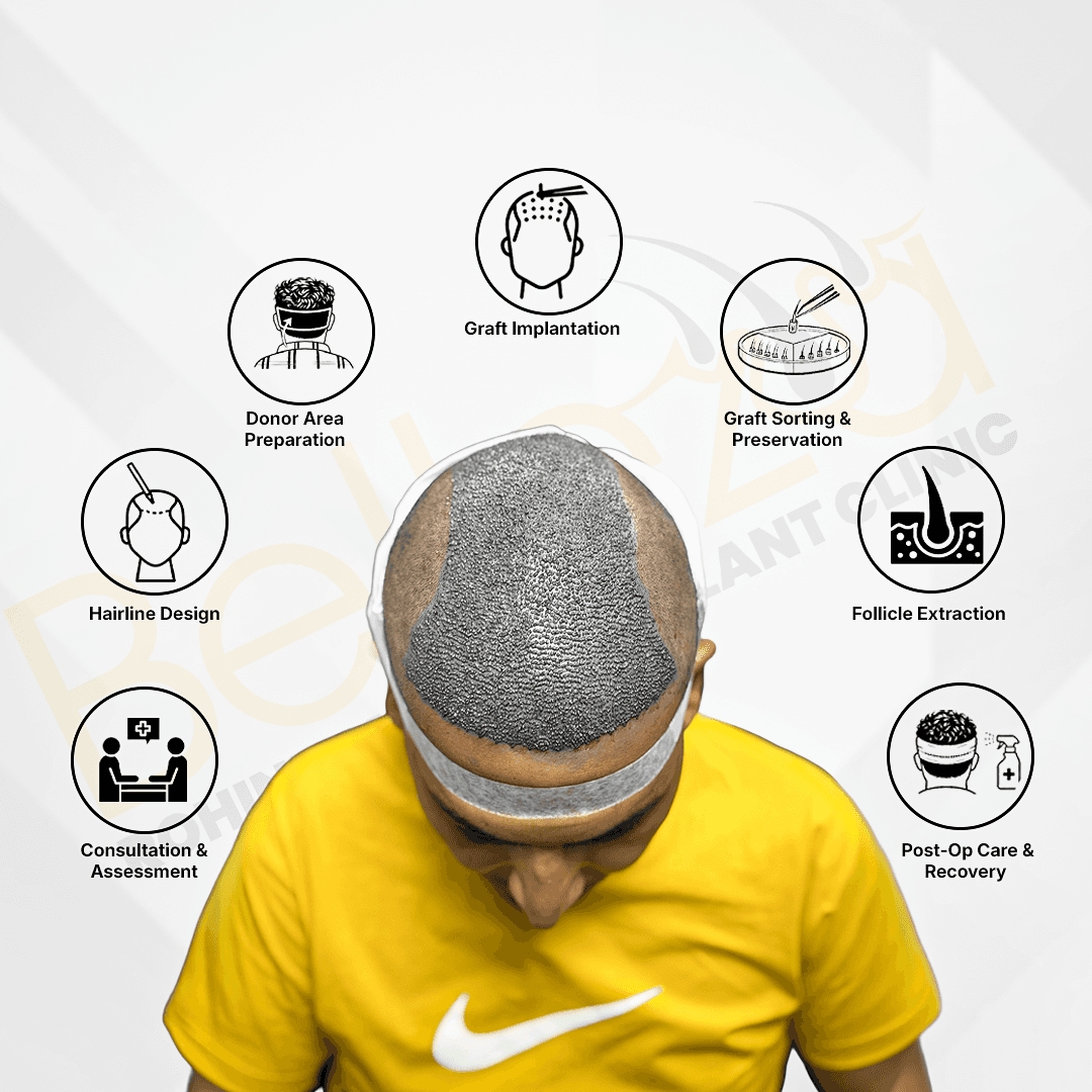 Hair Transplant Process Illustration