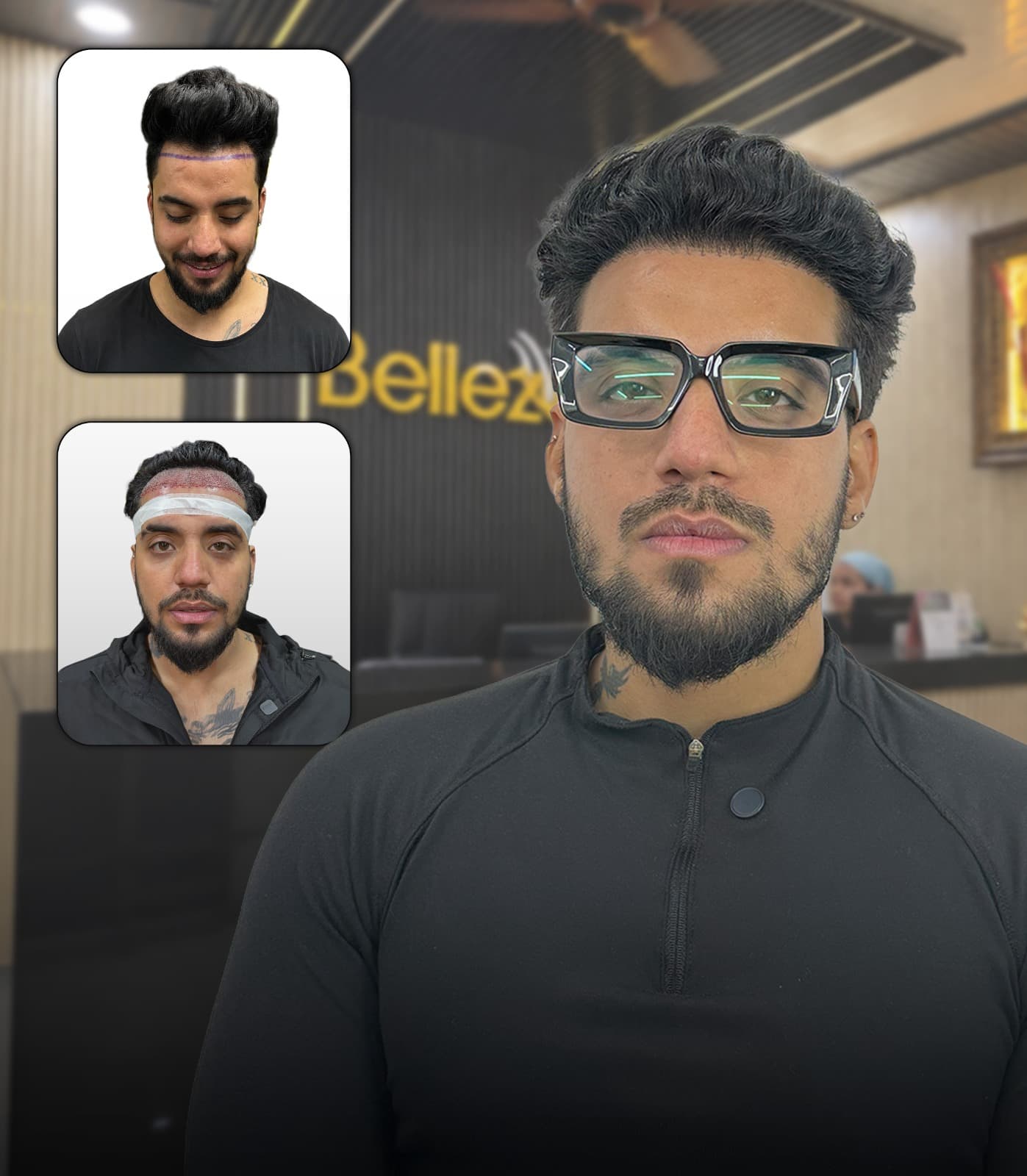 Rebuild Your Hairline, Restore Your Confidence