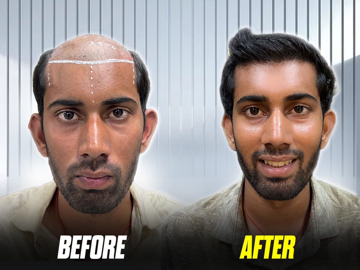 Abhishek’s remarkable hair transplant transformation.