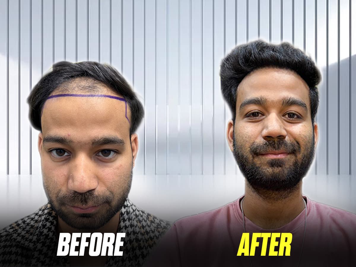 Vinay’s outstanding hair transplant transformation.