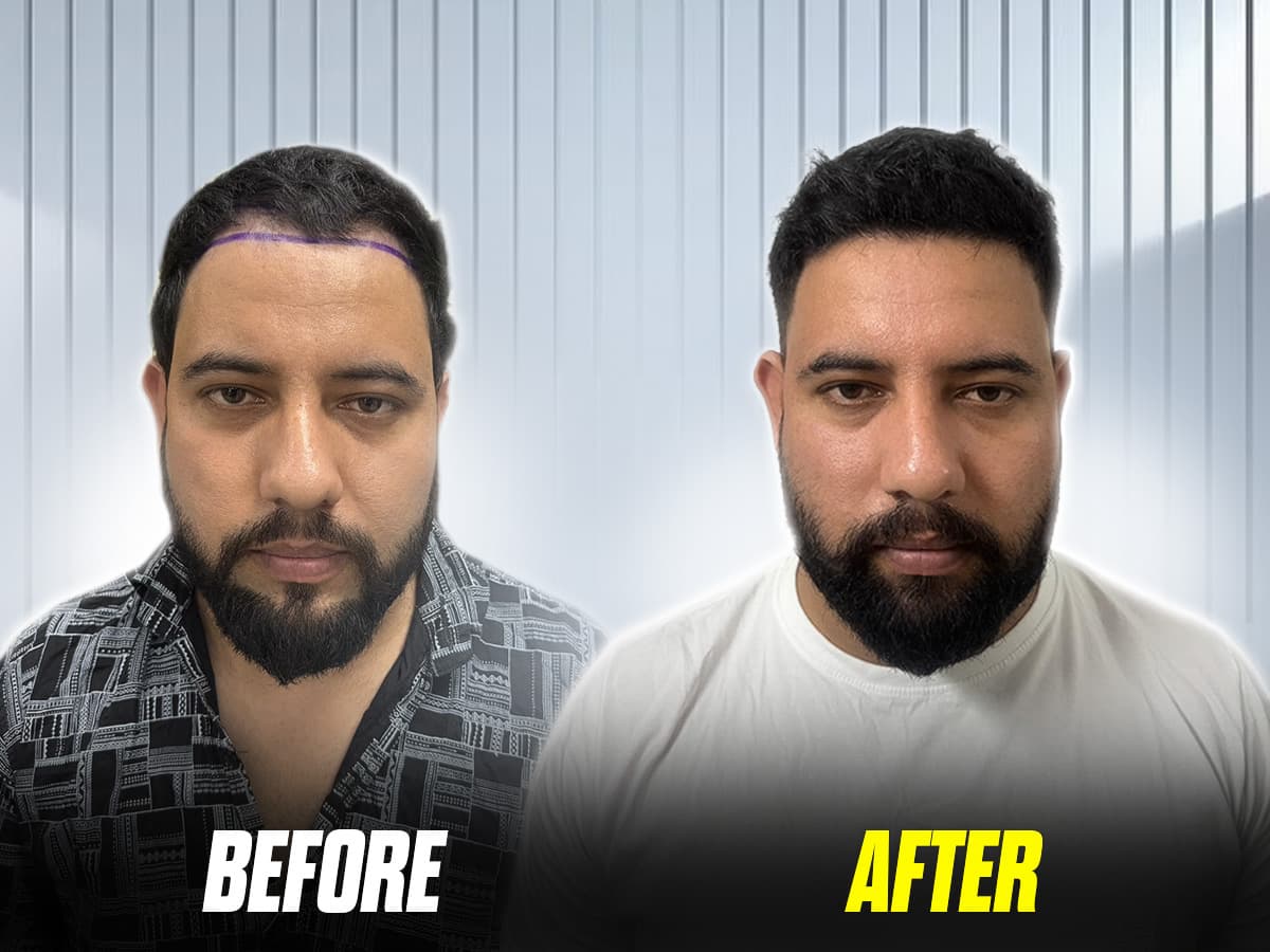 Gaurav’s remarkable hair transplant transformation