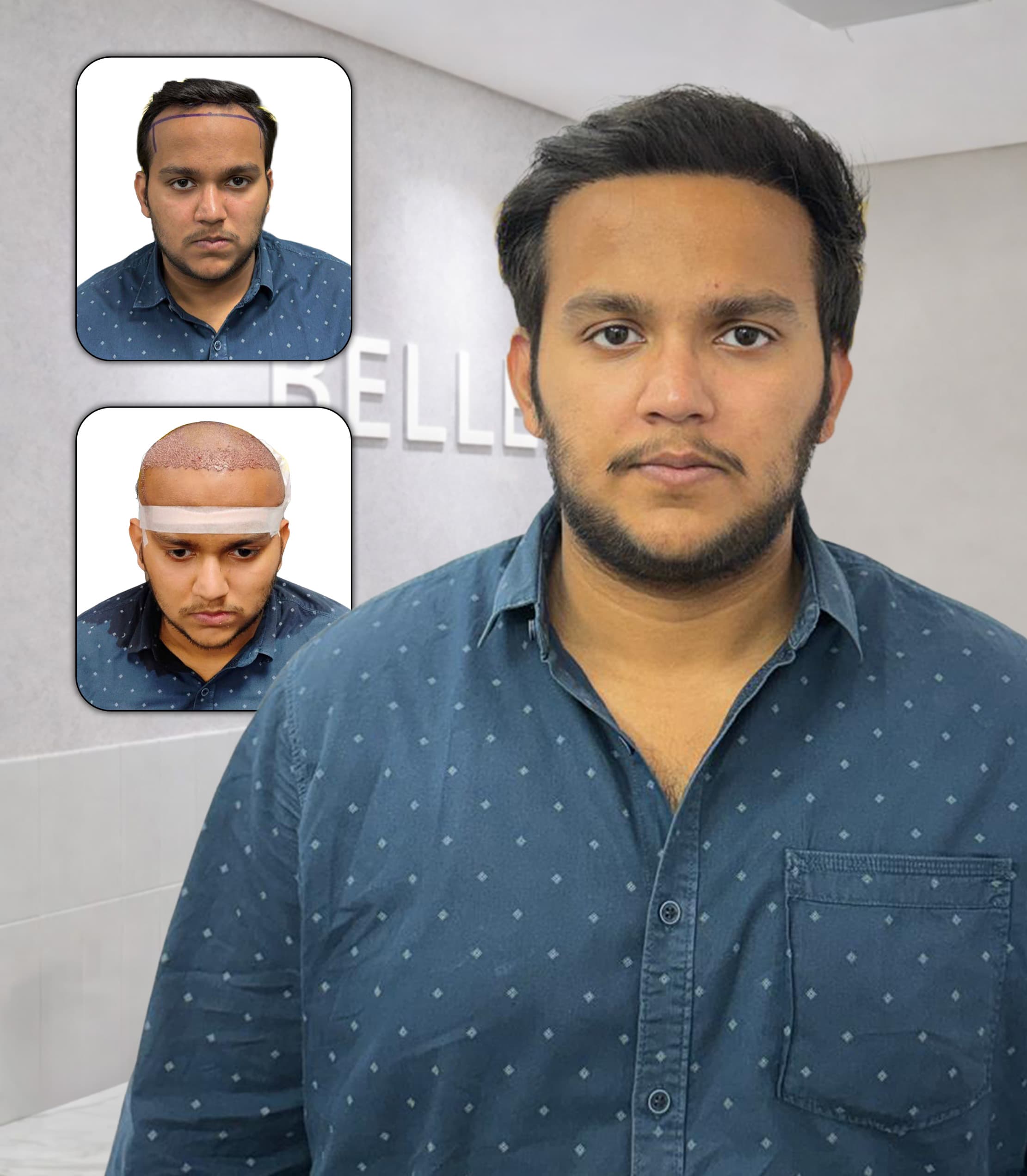 See Our Hair Transplant Transformations