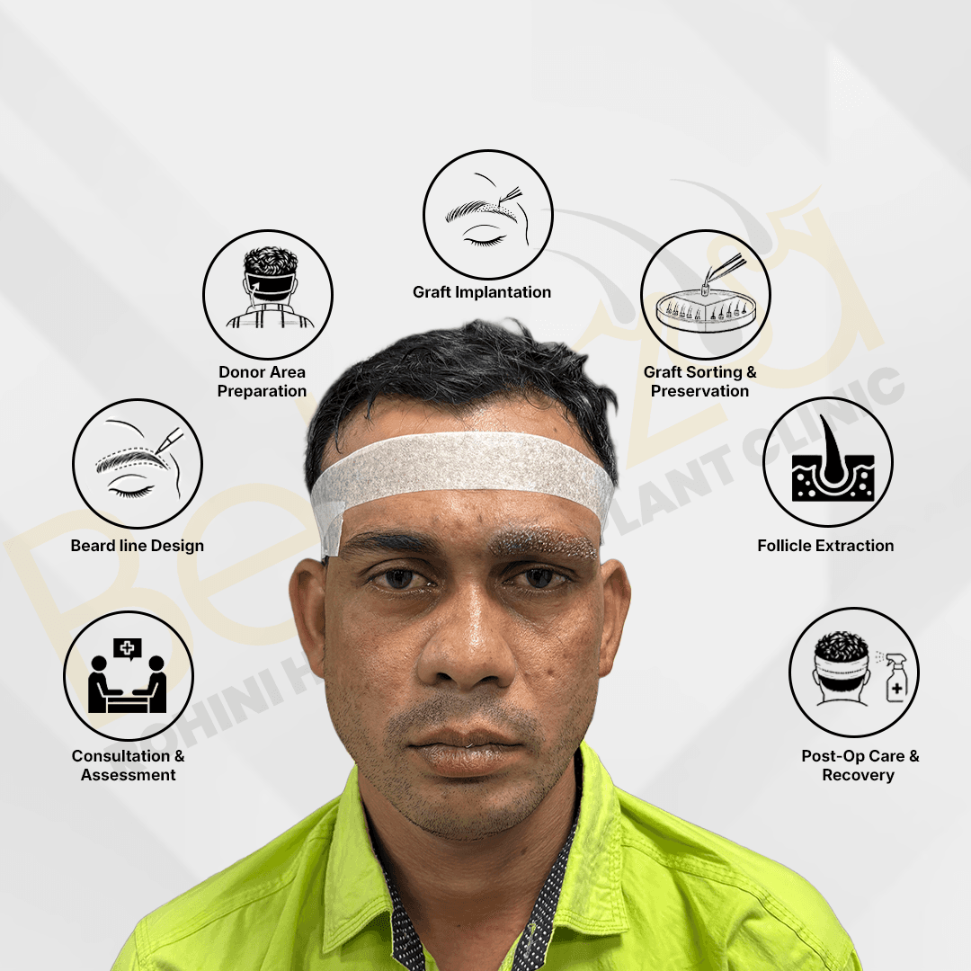 Hair Transplant Process Illustration