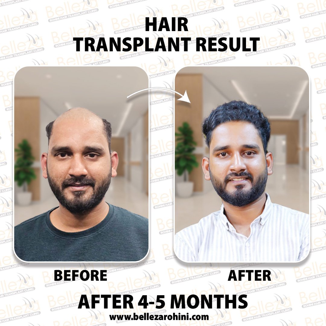 hair transplant results