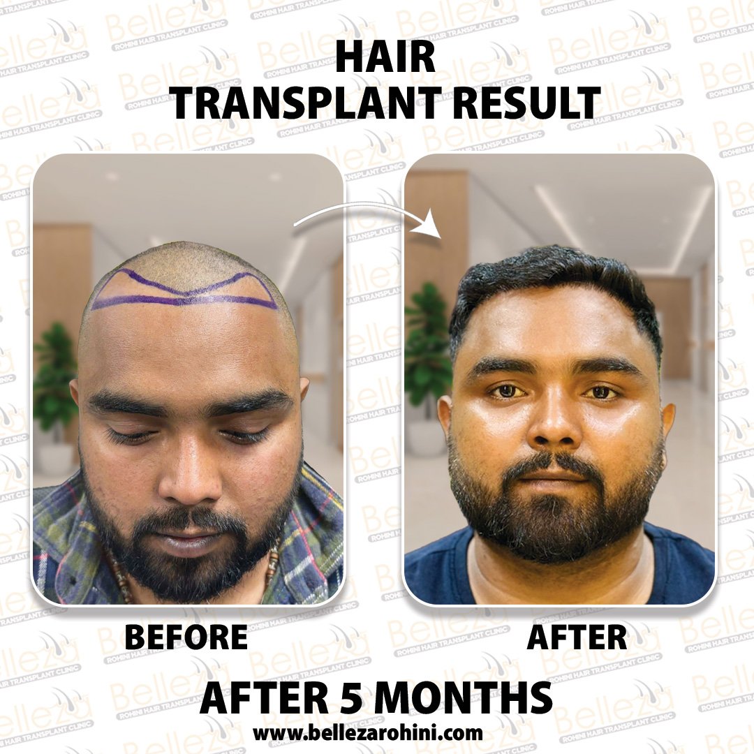 hair transplant results