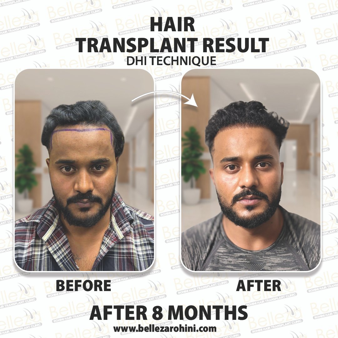 hair transplant results