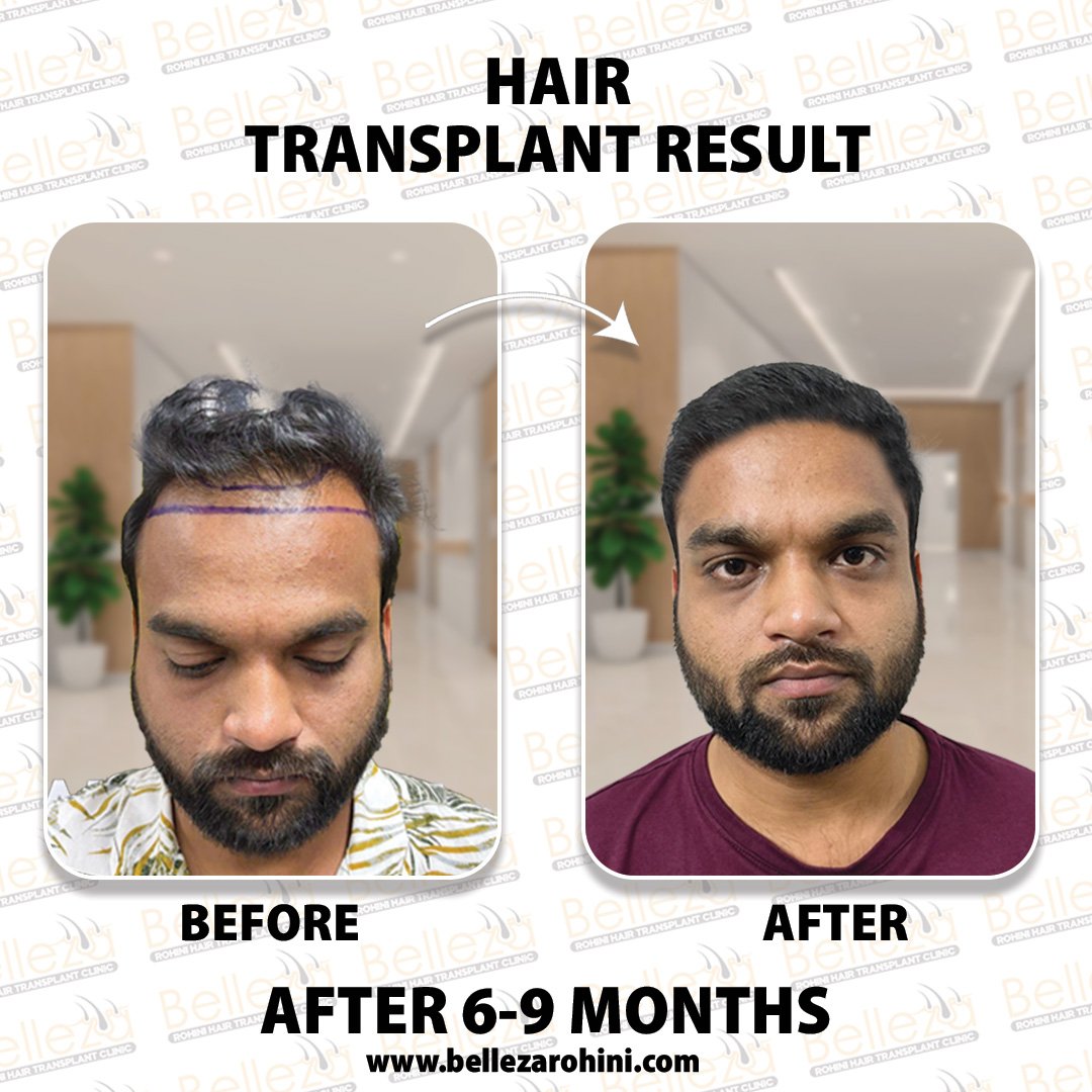 hair transplant results