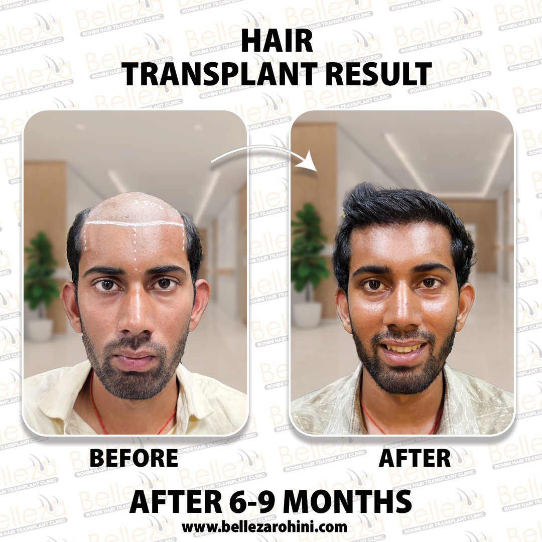 hair transplant results