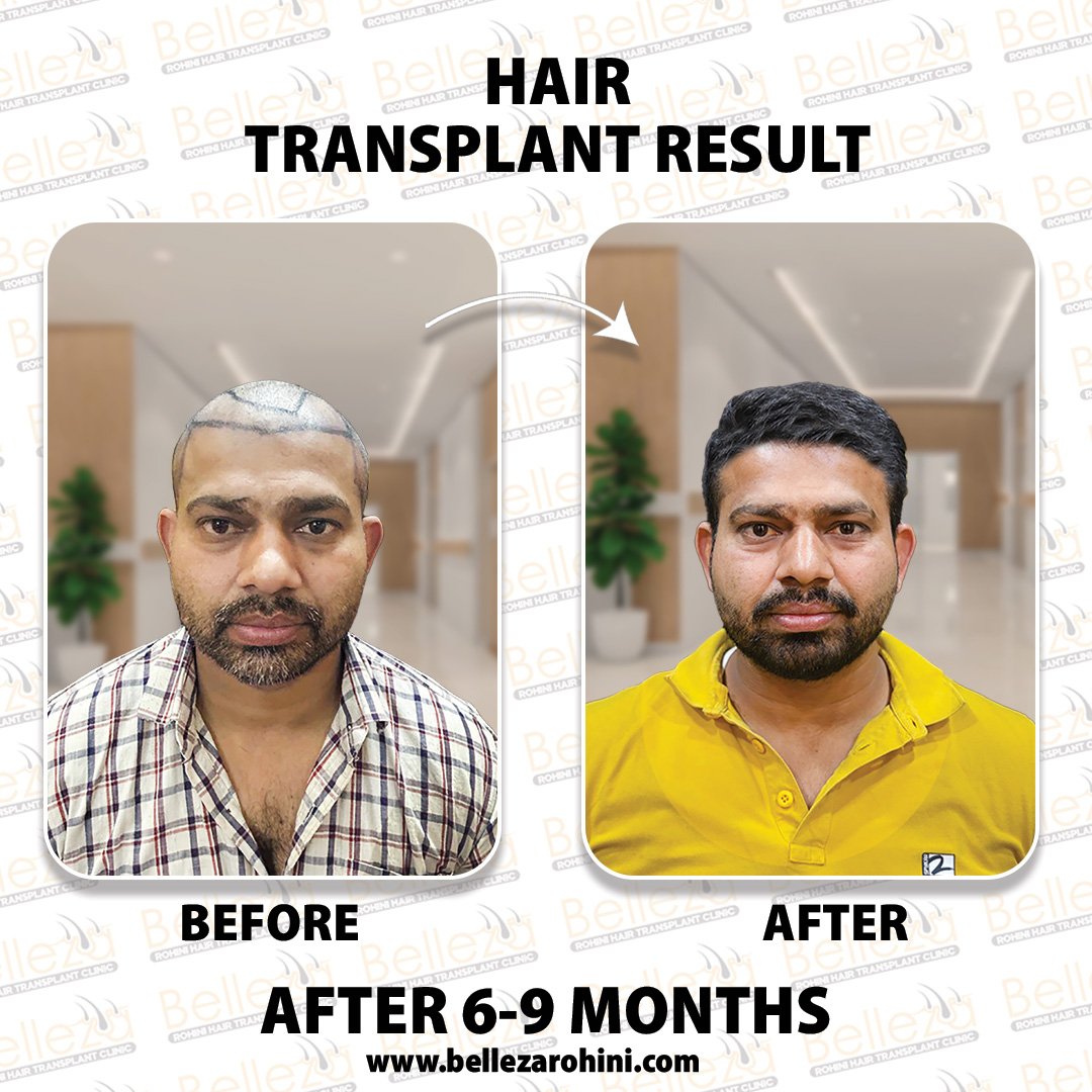 hair transplant results