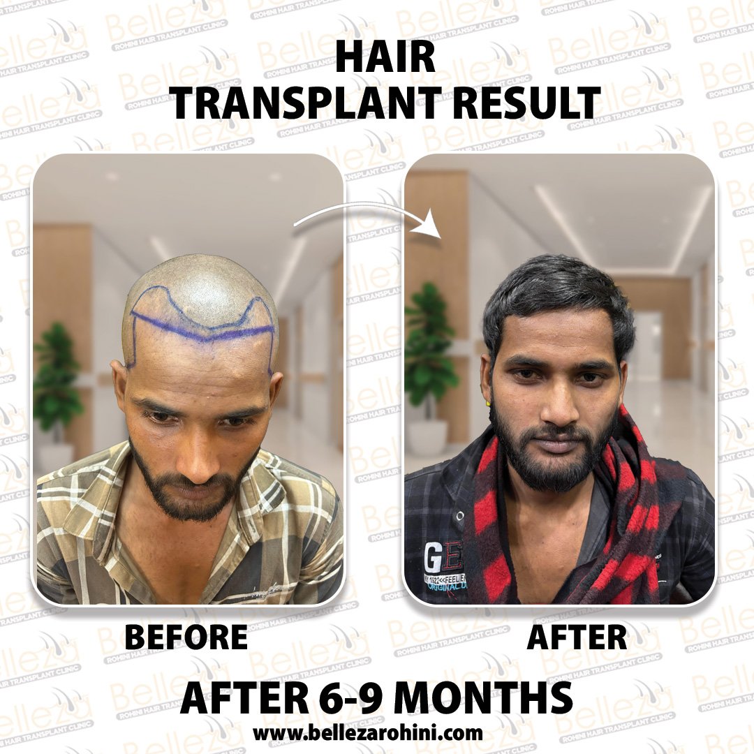 hair transplant results