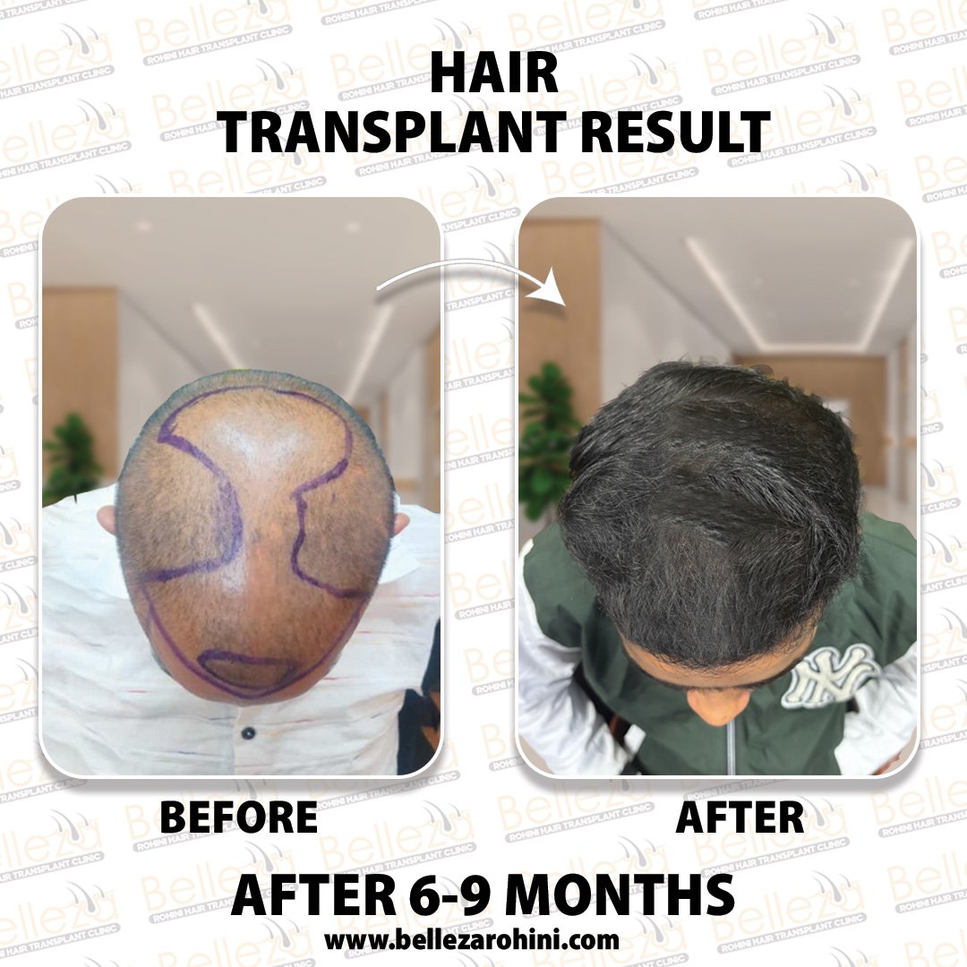 hair transplant results