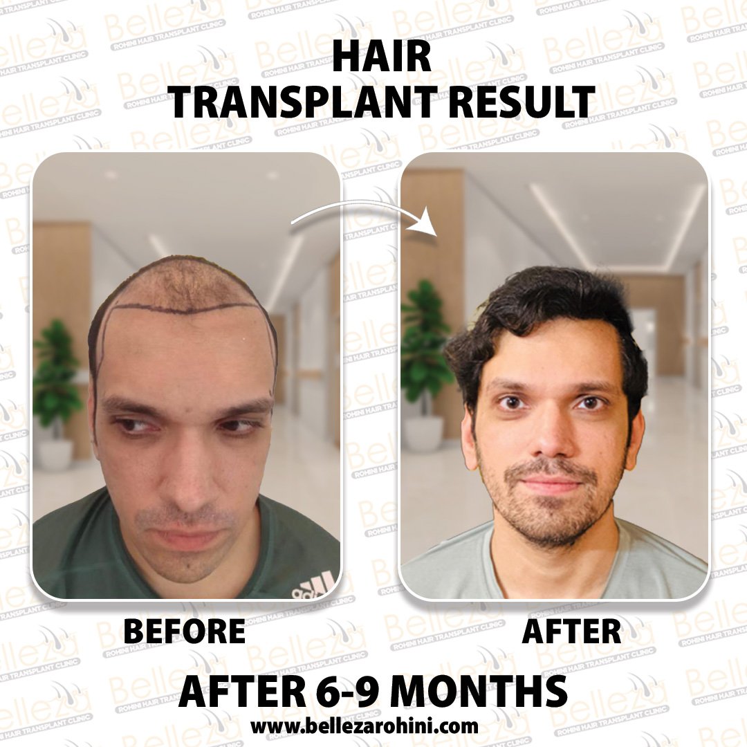 hair transplant results