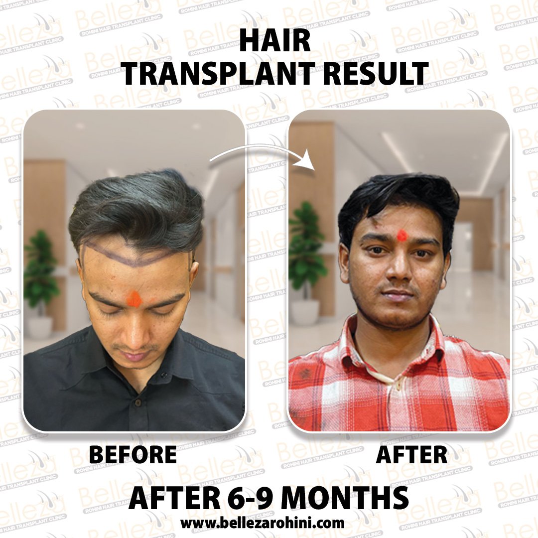 hair transplant results