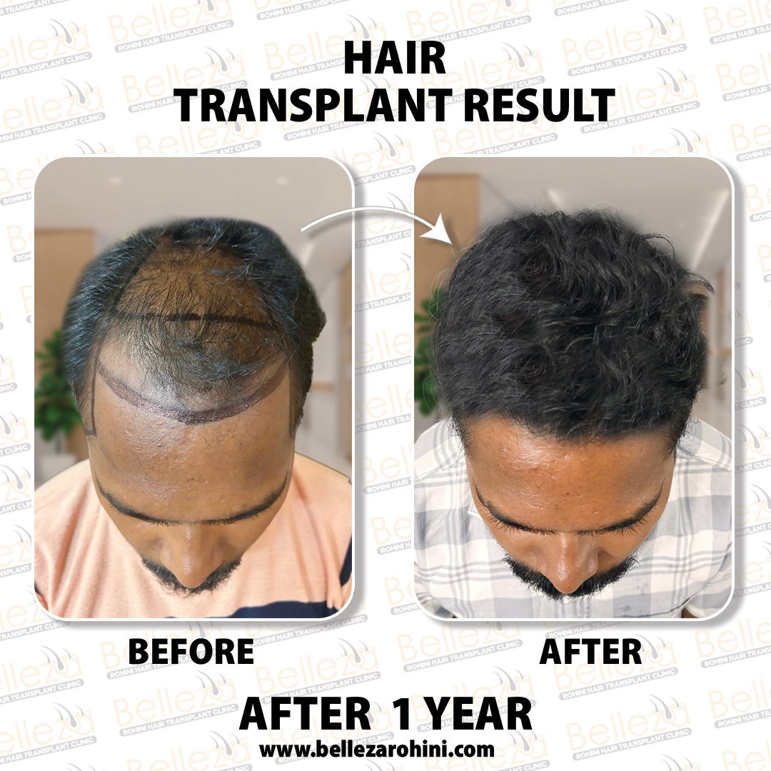 hair transplant results